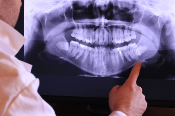 Best Emergency Root Canal Treatment in Hebron, IN