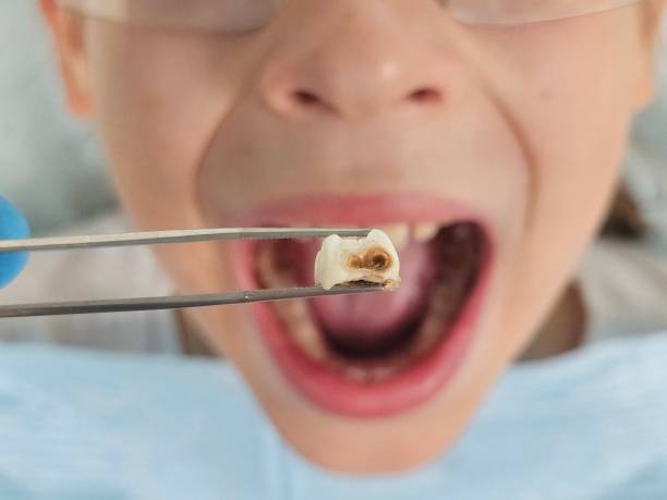 Best Broken or Cracked Tooth Emergency Dentist in Hebron, IN